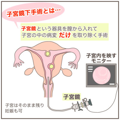 子宮鏡下手術とは。子宮鏡という器具を膣から入れて子宮の中の病変だけを取り除く手術。子宮はそのまま残り妊娠も可。子宮内を映すモニター。